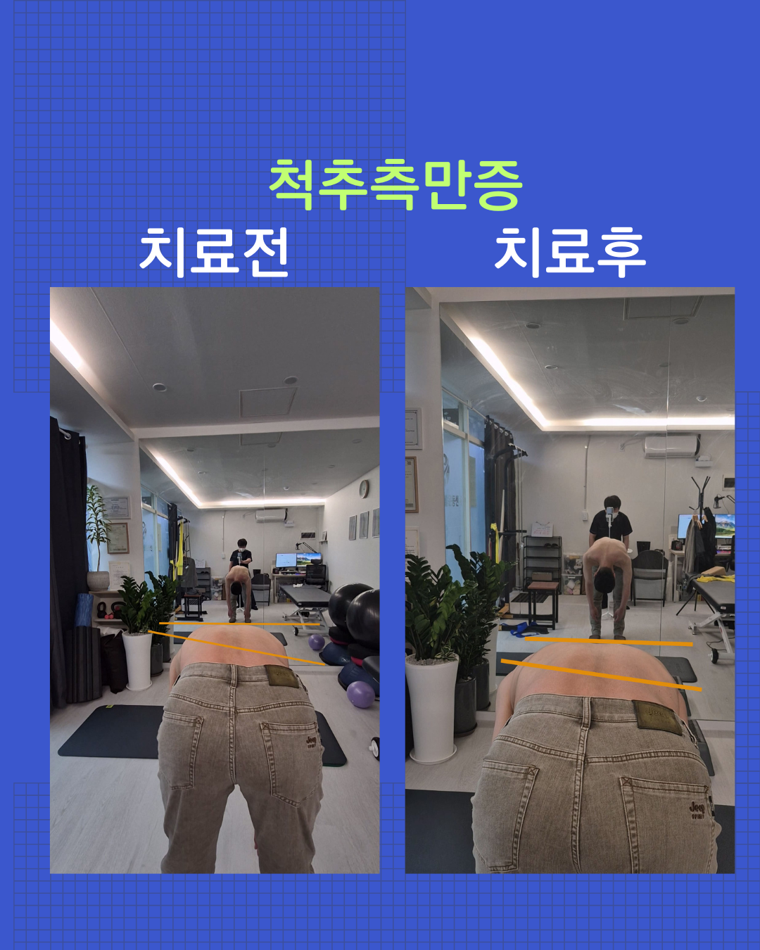 척추측만증 치료 전후 - 기능 비교